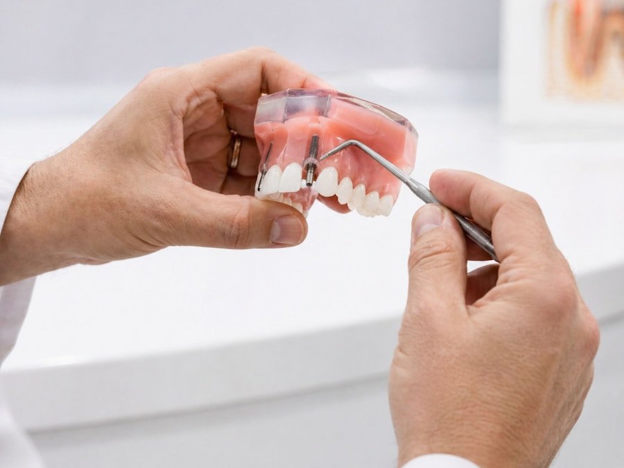 Dental implant screw demonstrated on a teeth model