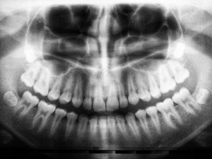 Dental X-ray scan used to plan wisdom tooth removal
